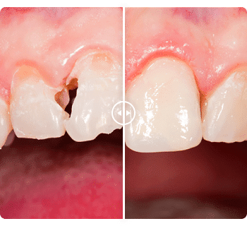 The Ten Commandments Of price of veneers in India